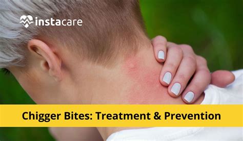 massage bites|Chigger Bites: Treatment and Prevention .